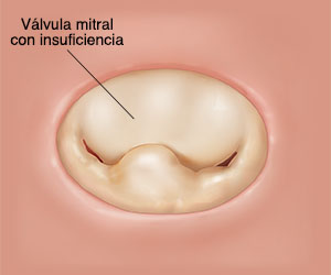 Vista superior de una válvula mitral cerrada con insuficiencia.